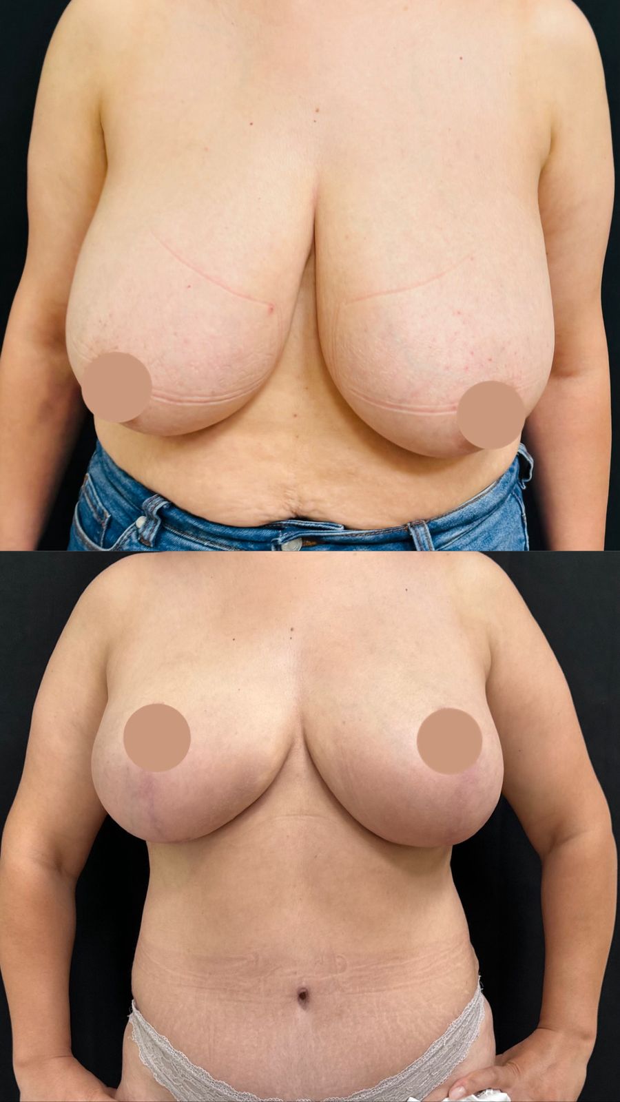 Breast reduction before and after