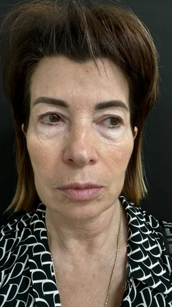 Pre-operative front photograph of the patient before combined deep plane facelift and blepharoplasty.