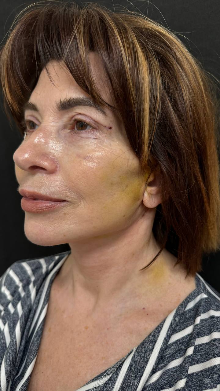 Early postoperative three-quarter view after combined deep plane facelift and blepharoplasty, showing visible bruising and sutures during healing.