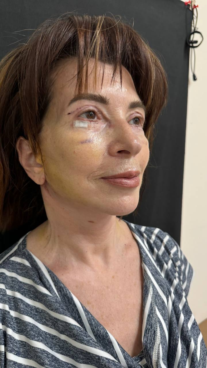 Early postoperative three-quarter view after combined deep plane facelift and blepharoplasty, showing a small dressing, sutures and bruising during healing.