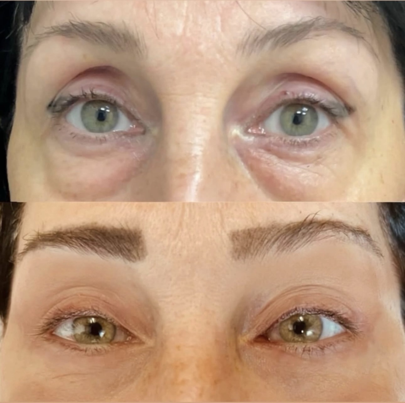 Before and after comparison photographs of eyelid surgery, front view.