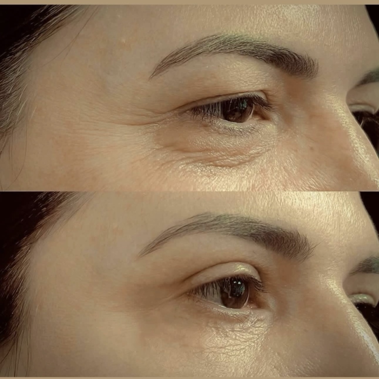 Before and after comparison photographs of eyelid surgery, side view.