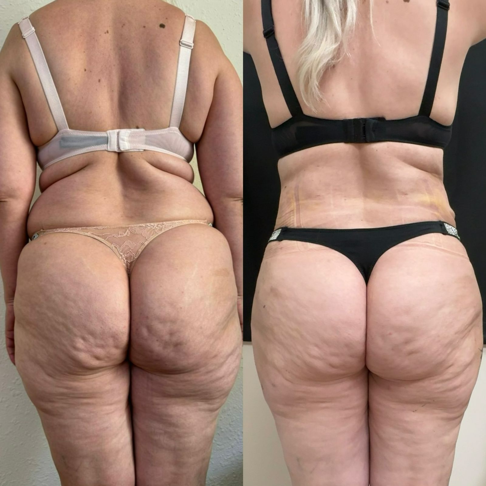 Liposuction