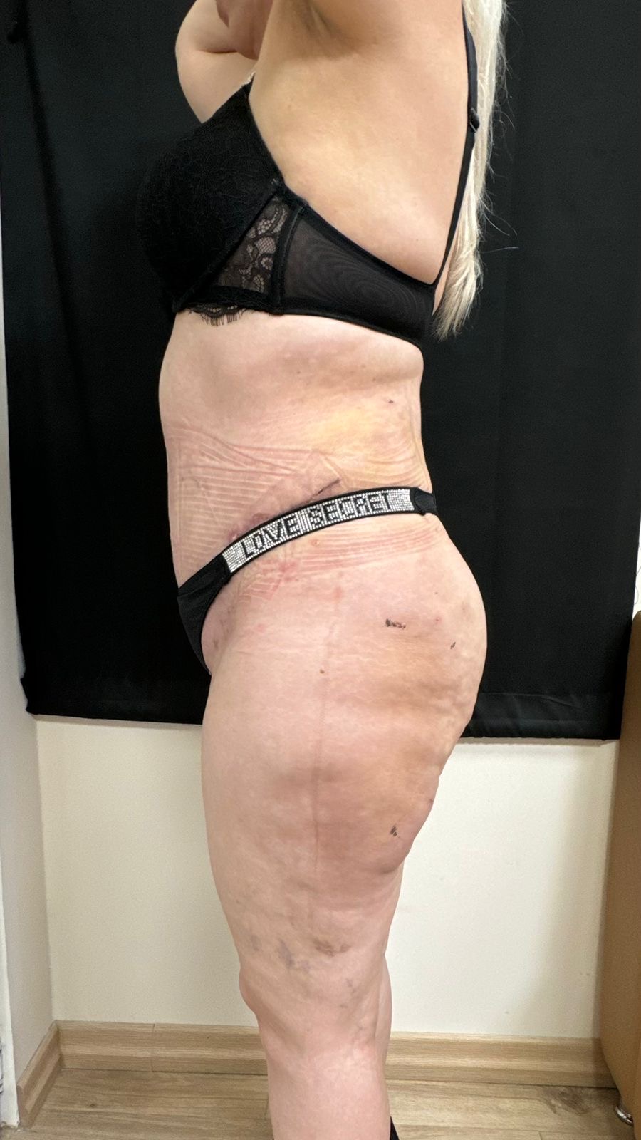 Tummy Tuck — After (Early Recovery)