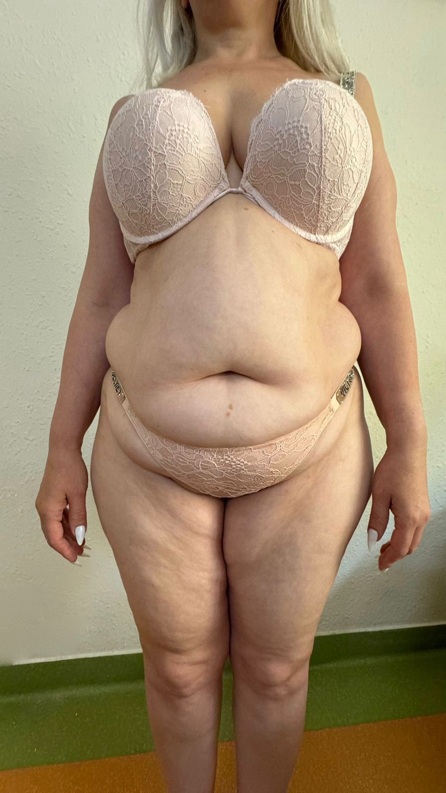 Tummy Tuck — Before