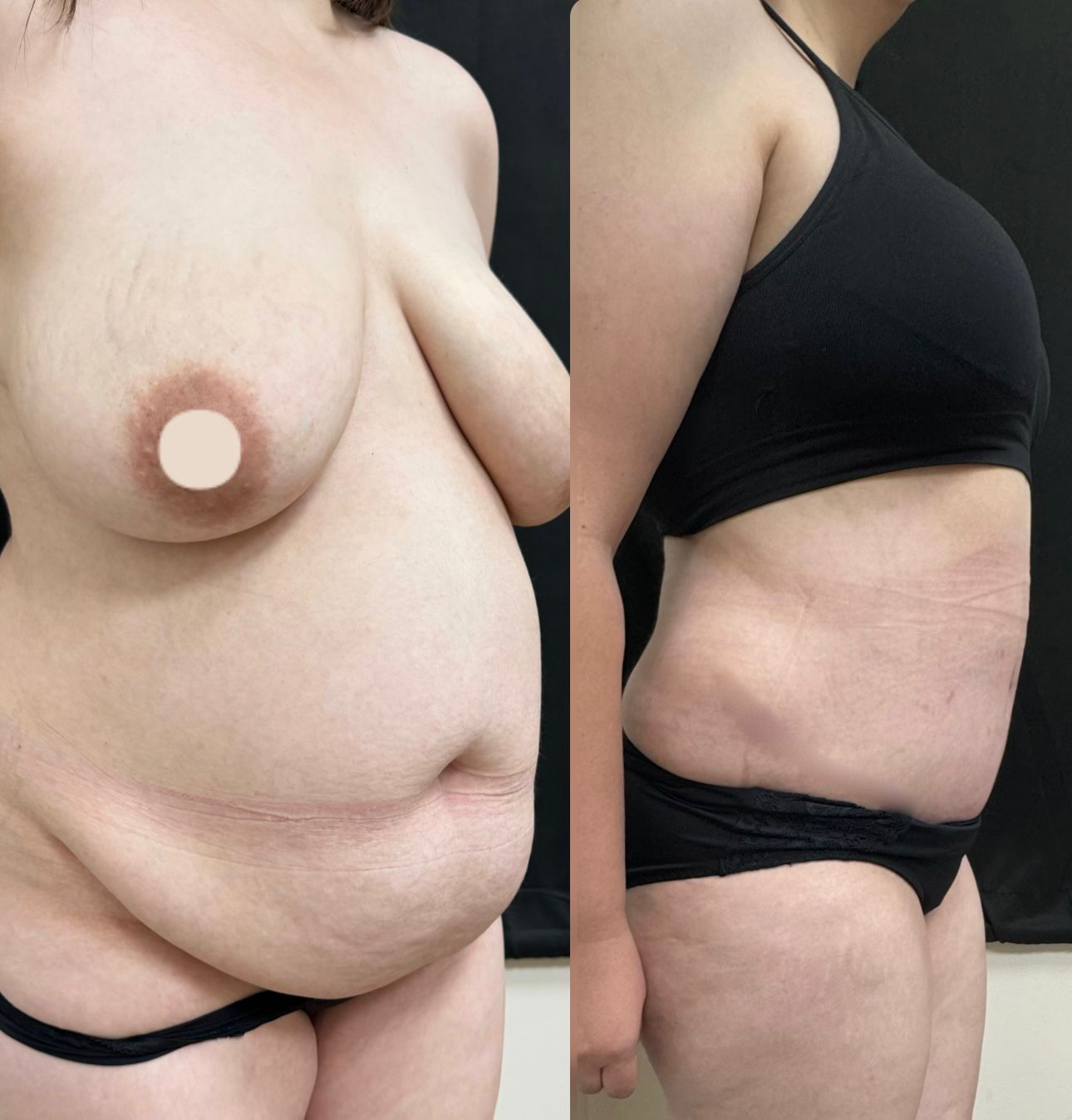 Tummy Tuck / Abdominoplasty